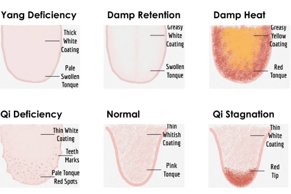 Learn Tongue Analysis, Body Constitution, and Dietary Therapy in 12 Minutes